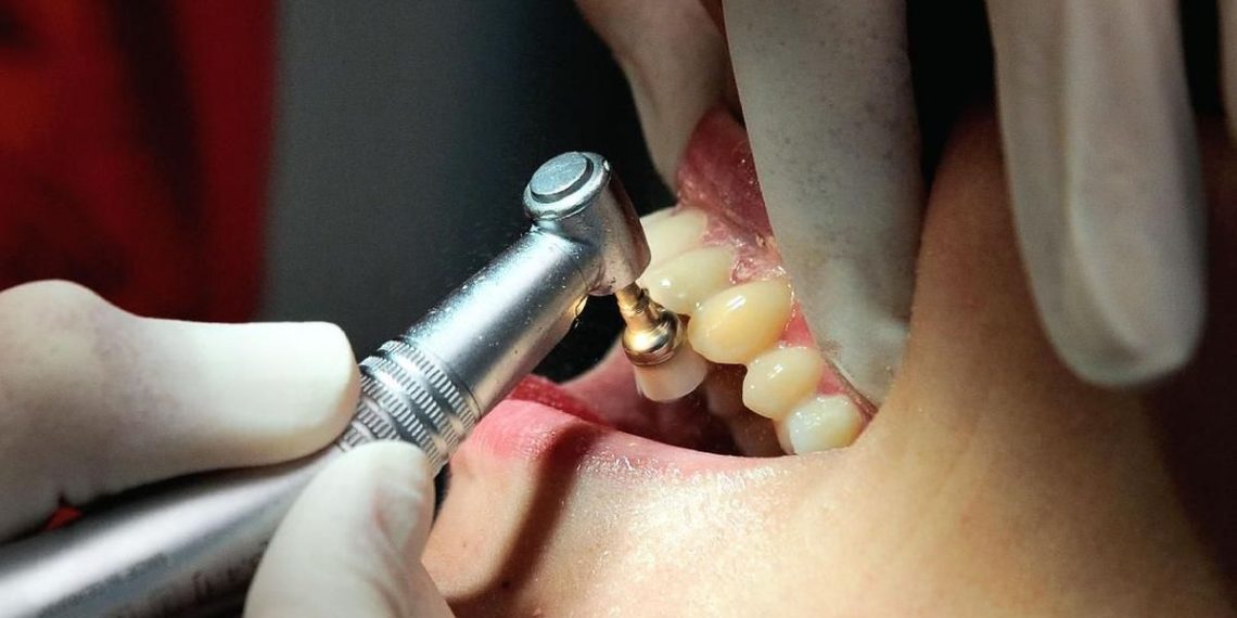 Perawatan Gigi yang Ditanggung BPJS Kesehatan Mulai dari Cabut Hingga Scaling