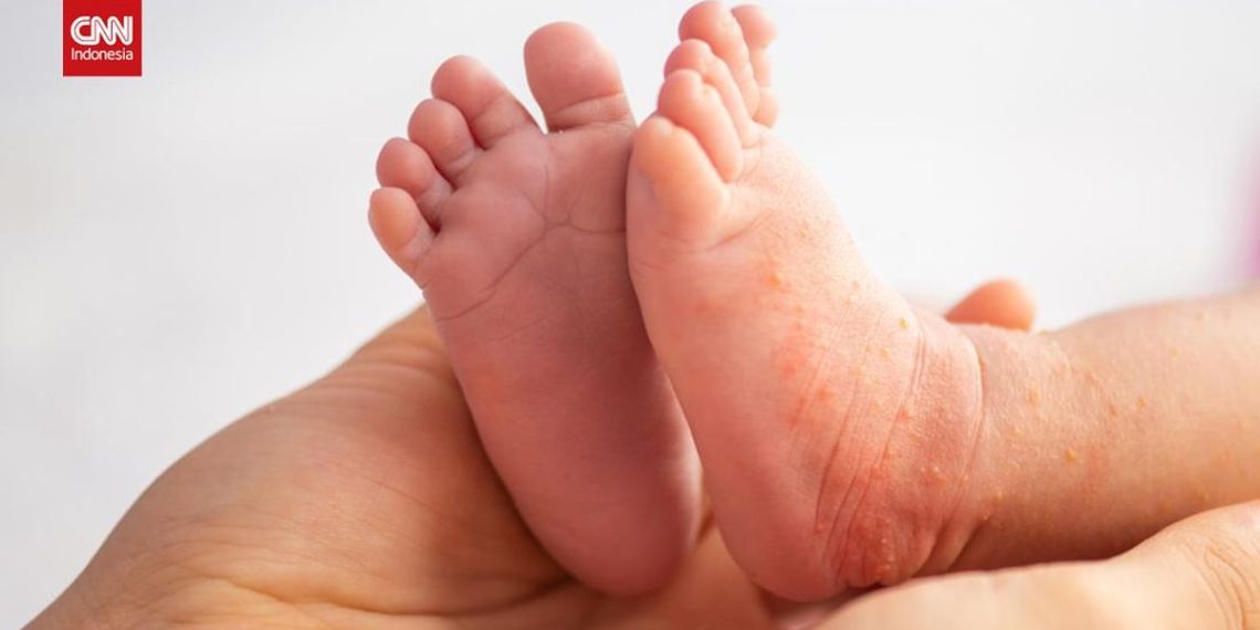 Waspada Campak, Langkah Pencegahan dan Cara Penanganannya