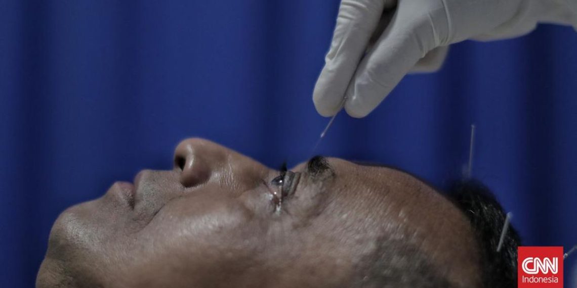 Manfaat Terapi Akupunktur Medis yang Perlu Diketahui