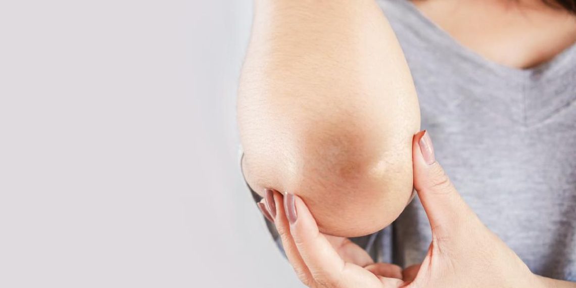 5 Cara Efektif Memutihkan Siku supaya Kulit Tidak Terlihat Belang