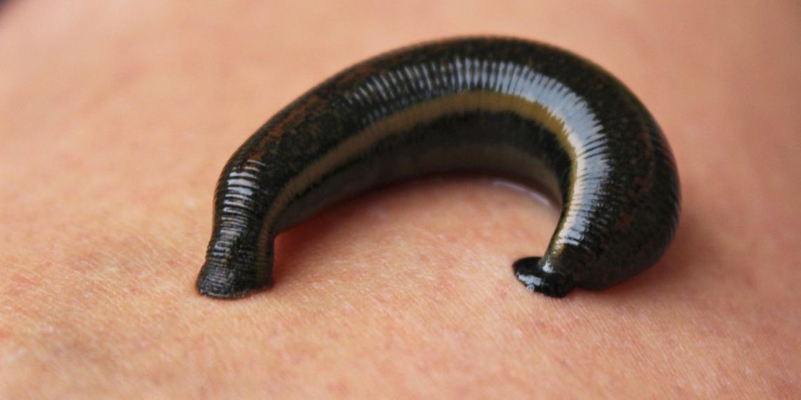 Mimisan Berhari-hari, Lintah Ditemukan Bersarang di Hidung Pria