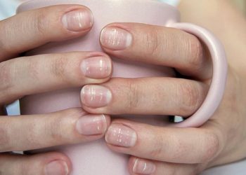 Garis Putih pada Kuku, Kenali Penyebab dan Solusinya