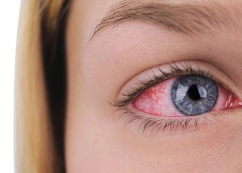 Urat Merah di Mata, Apakah Berbahaya? Berikut Penjelasannya