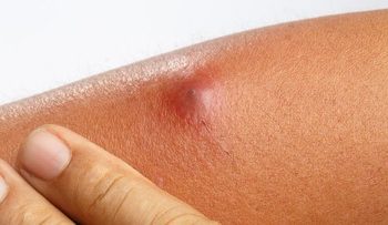 5 Cara Mengatasi Bisul Mengeras Tanpa Perlu Dipecahkan