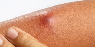 5 Cara Mengatasi Bisul Mengeras Tanpa Perlu Dipecahkan