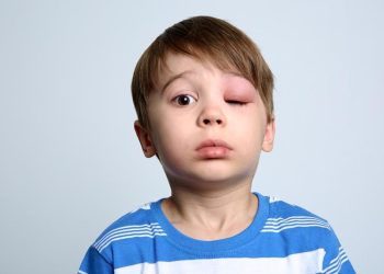 7 Metode Cepat untuk Mengatasi Mata Bengkak