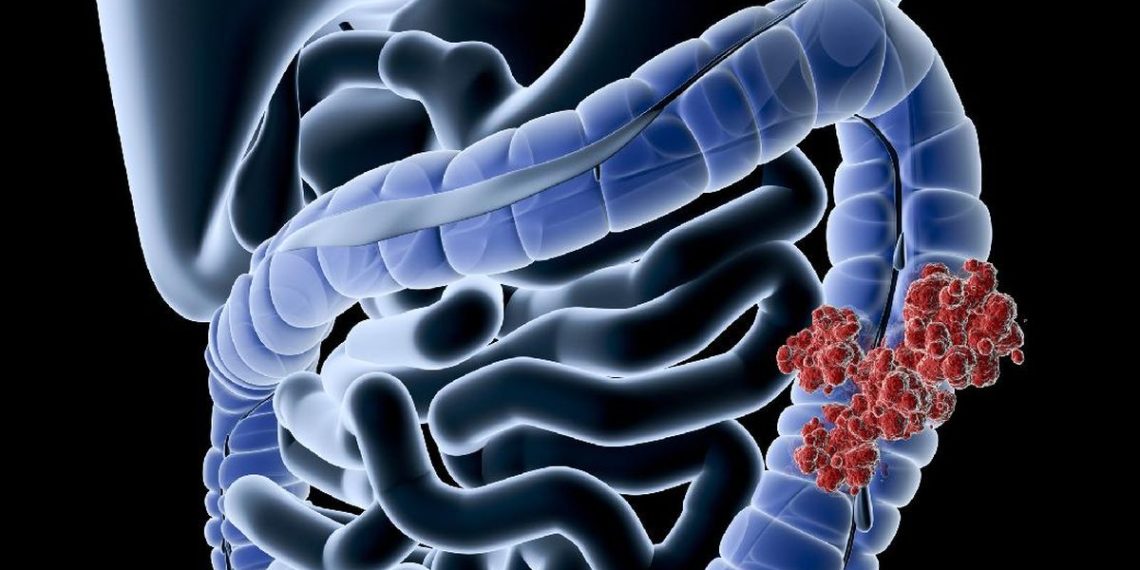 Gen Z Banyak Terkena Kanker Usus Besar, Ini Makanan Penyebab Utamanya