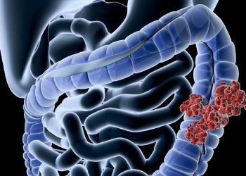 Gen Z Banyak Terkena Kanker Usus Besar, Ini Makanan Penyebab Utamanya